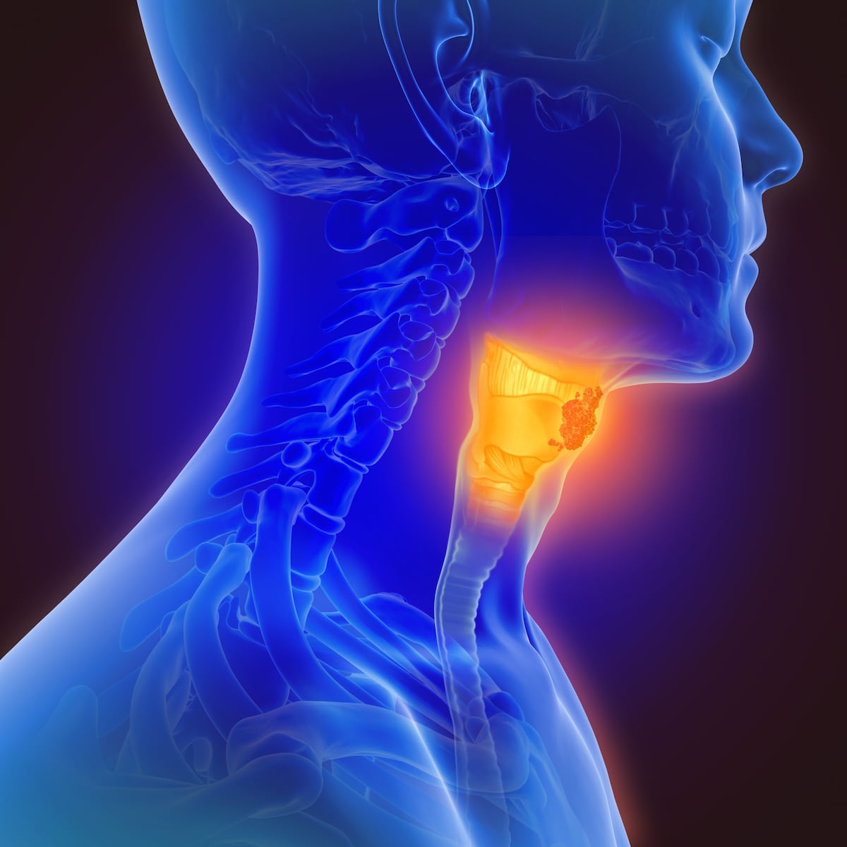 3 maneras de prevenir el cáncer de cabeza y cuello